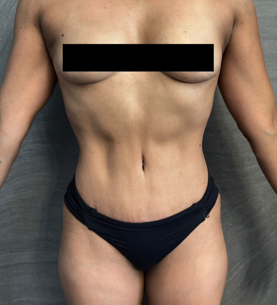 Resultado de lipoabdominoplastia, abdome