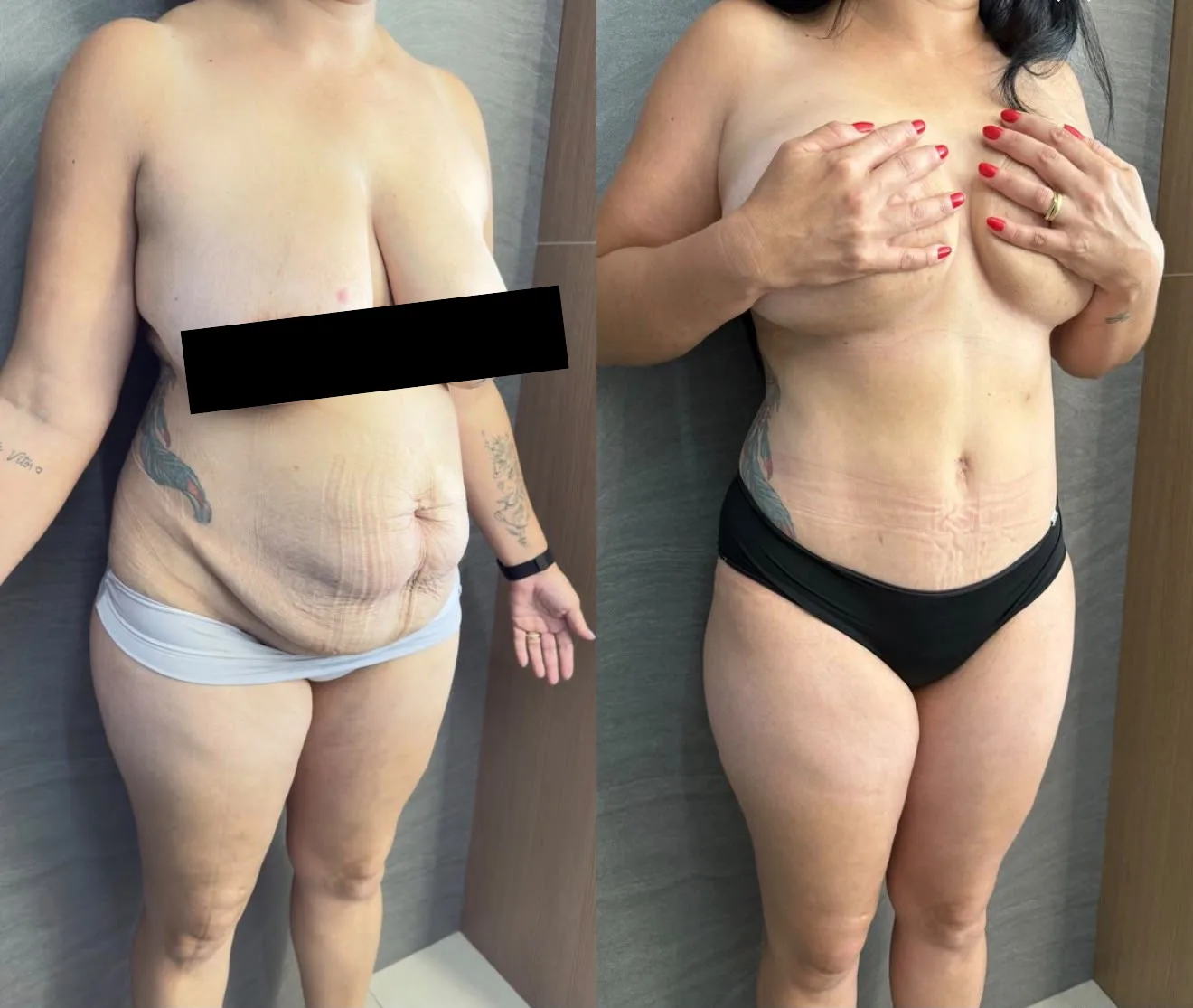 Resultado de correção de grande diástase, antes e depois