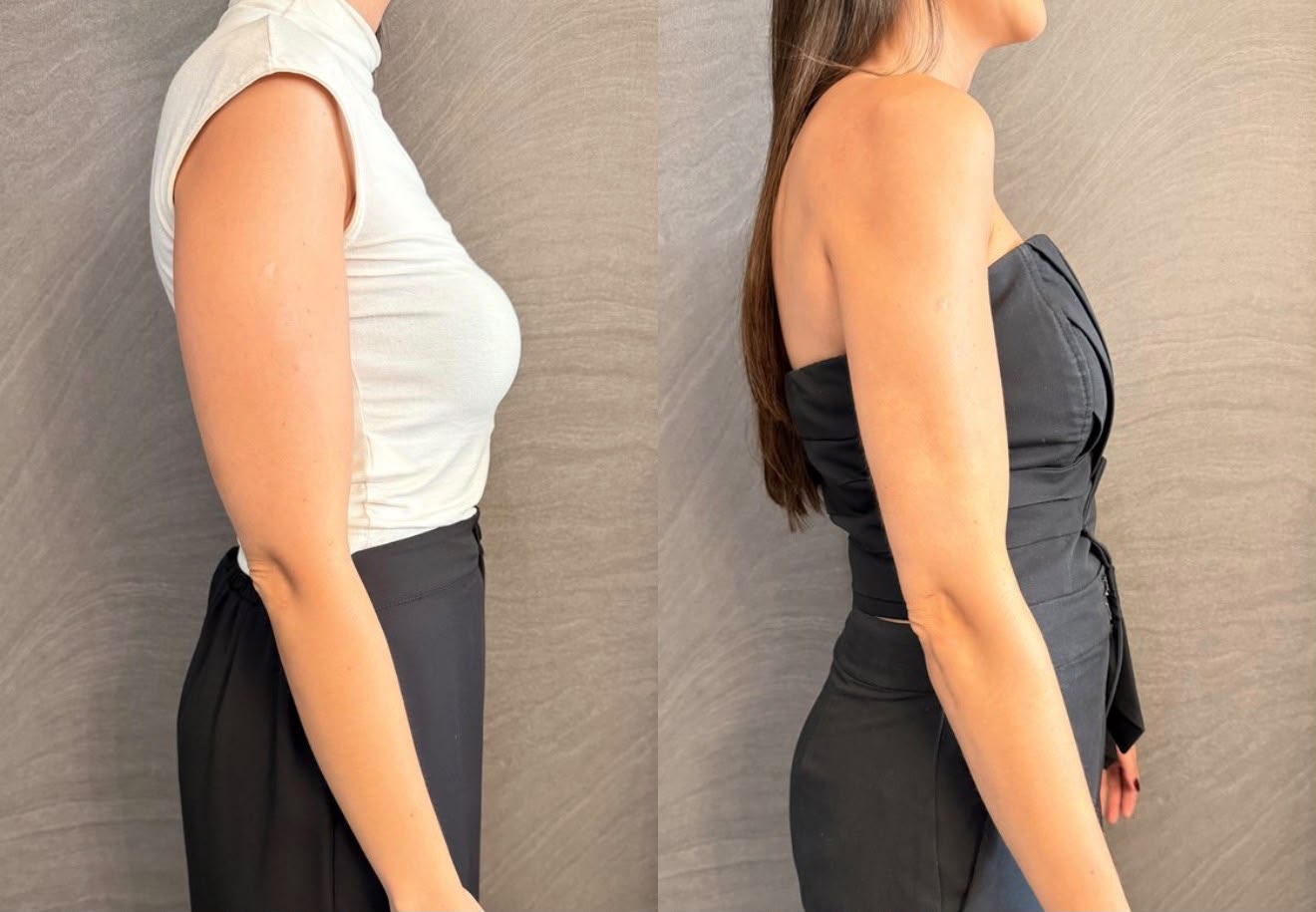 Resultado de cirurgia de braços, antes e depois