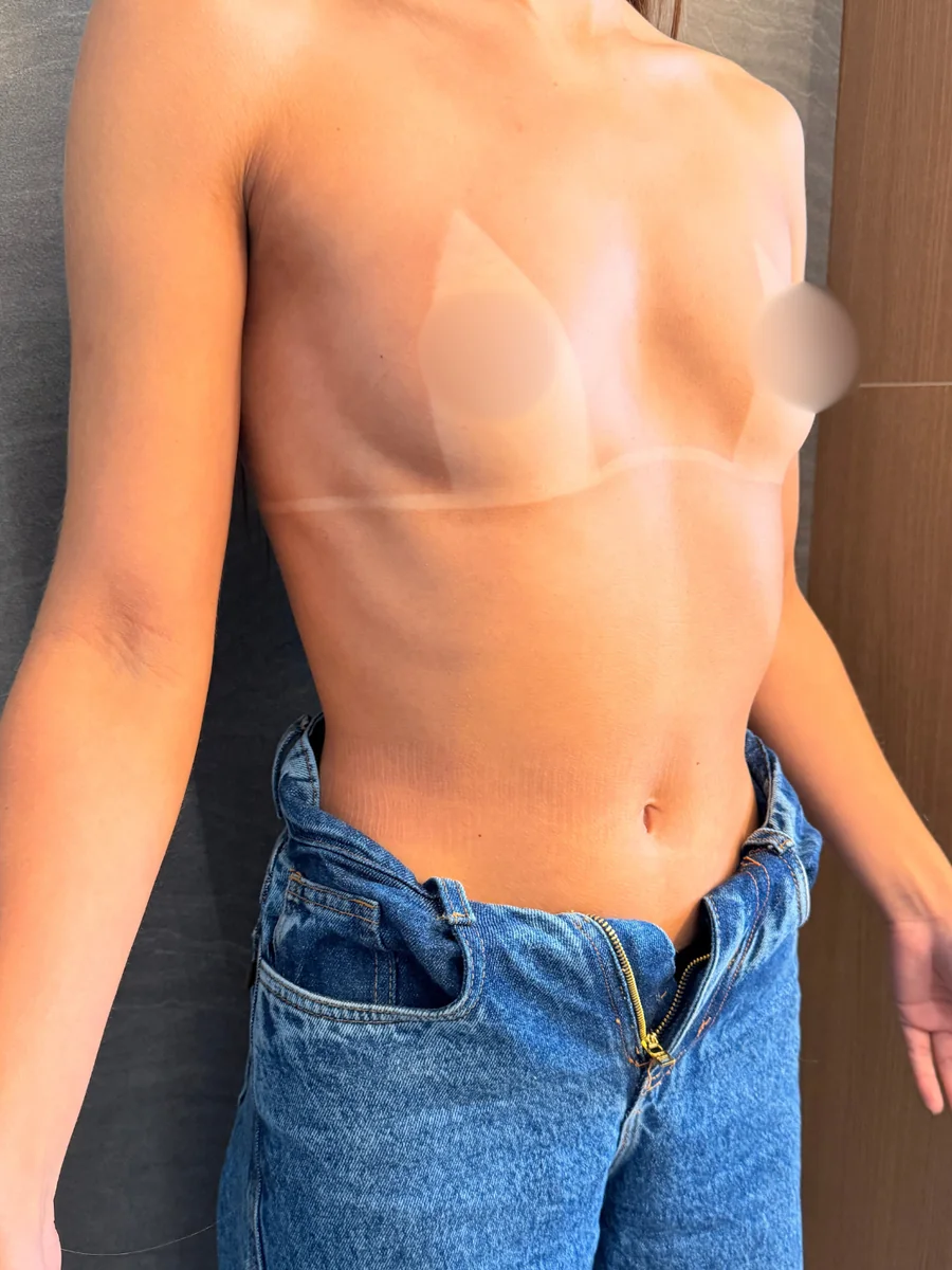 Resultado de prótese de mama, vista de perfil