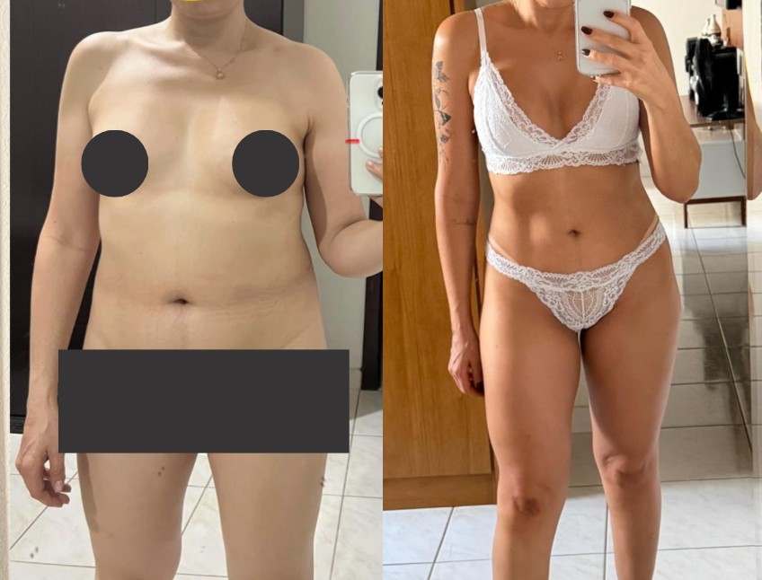 Resultado de lipoescultura, antes e depois