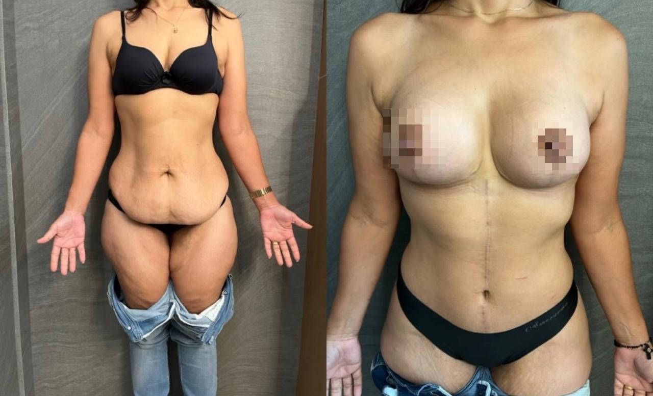 Resultado de cirurgia pós-bariátrica, antes e depois